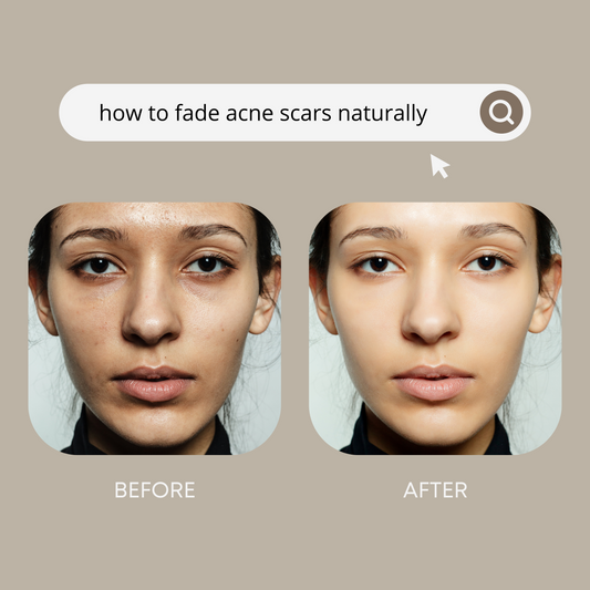 how to fade acne scars naturally