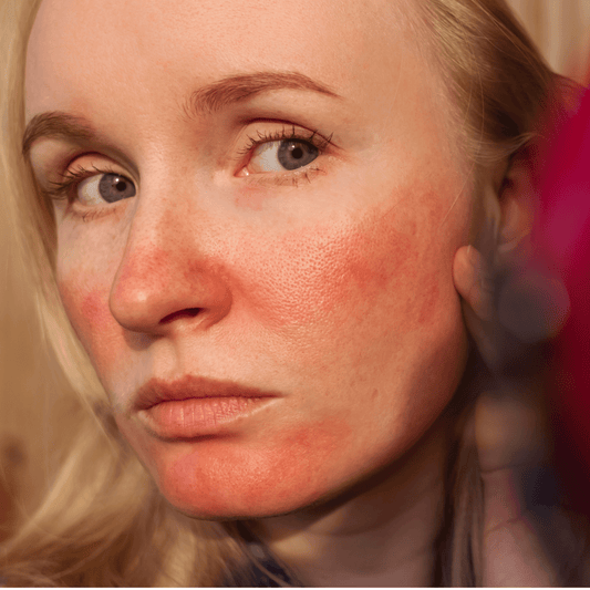 Will Rosacea Go Away on Its Own? What Experts Want You To Know - Claribelskincare.com